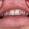 Crystal Round Pink Tooth Gems